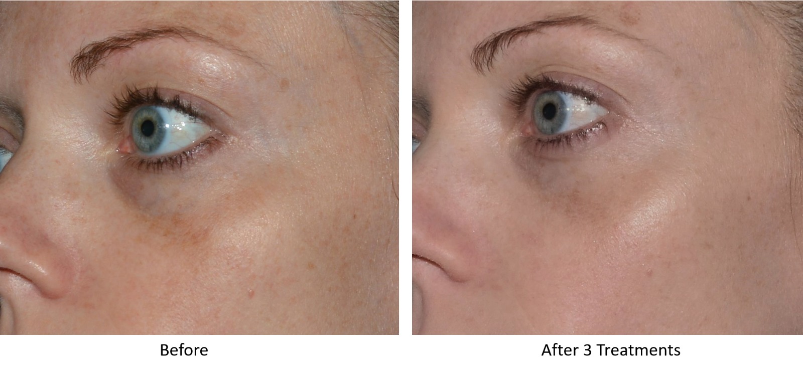 LaseMD Ultra Before and After - Sun Damage Treatment